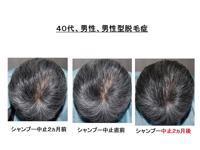 円形脱毛症　病院